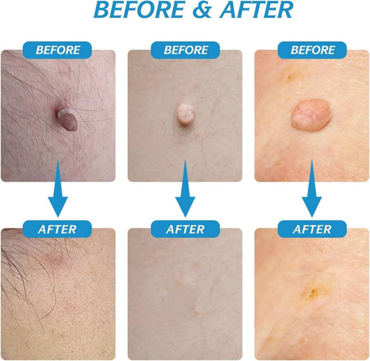 2 in 1 Skin Tag Remover Kit - Painless - Comforzo