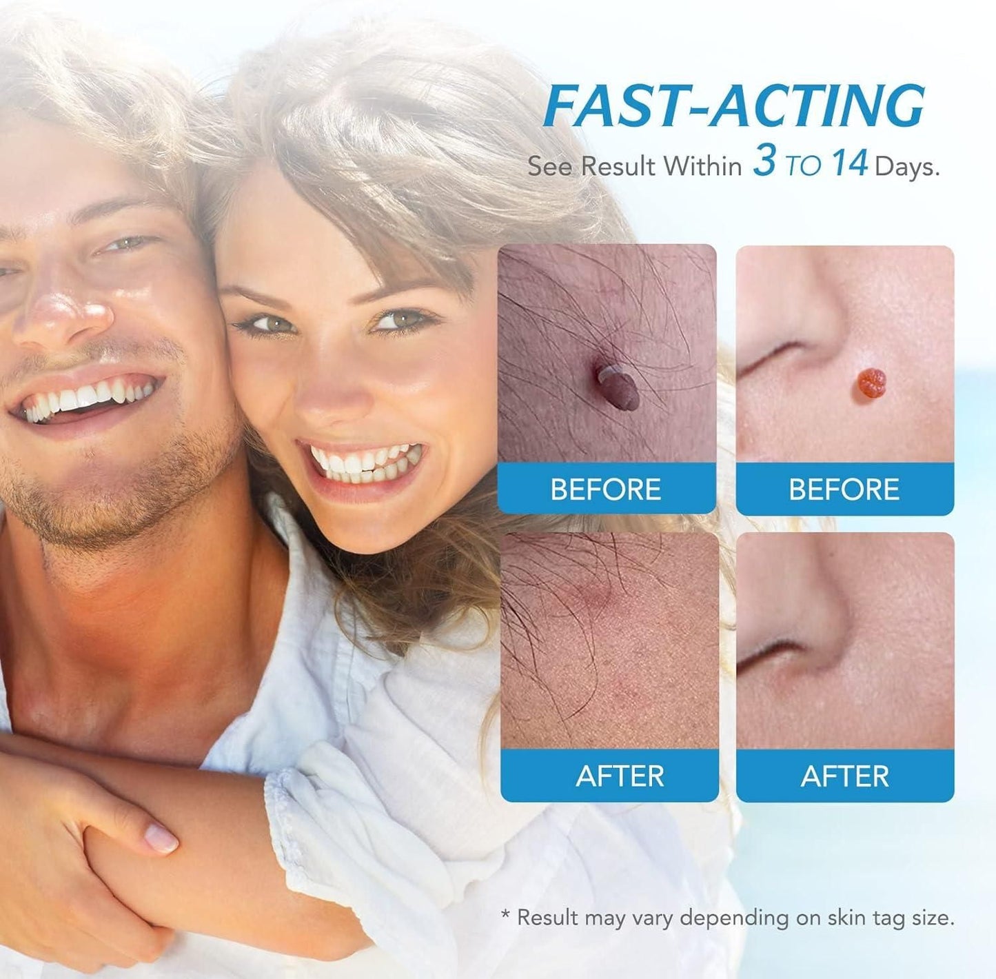 2 in 1 Skin Tag Remover Kit - Painless - Comforzo